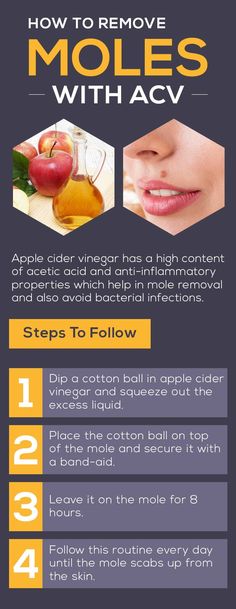 Apple Cider Vinegar Mole Removal: Simple Methods that Really Work Apple Cider Vinegar Warts, Warts Removal, Cancerous Moles, Dark Mole, Apple Cider Vinegar Remedies, Skin Moles, Mole Removal, Get Rid Of Warts, Unhealthy Diet