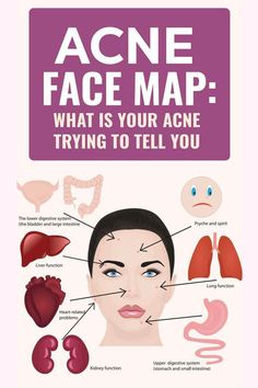 Acne Face Map: What is Your Acne Trying to Tell You? Acne Face Map, Face Map, Face Mapping Acne, Acne Face, Face Mapping, Clear Face, Large Intestine, Natural Body Care