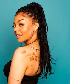 Shared by Girl Gaze and photographed by Sophie Mayanne, the photo is send a body-positive message to others with keloids. Body Imperfections, Acne Positivity, Skin Positivity, Facial Warts, Remove Skin Tags Naturally, Face Care Routine, Hair Half Up, Front Hair, Inspiring Message