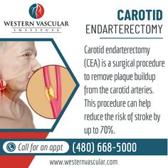 Carotid endarterectomy aims to reduce the risk of stroke by removing the plaque buildup from the carotid arteries. By restoring normal blood flow, the procedure helps prevent the development of a full-blown stroke or TIA. Carotid Endarterectomy, Phoenix Arizona, Blood Flow, Phoenix Az, Surgery, Disease