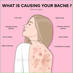 Struggling with back acne? Here are the possible causes | #Remediesforacneandscars #Bestacnetreatmentproducts #Blackheadsremoval #Pimplepopper #Skintreatmentsforacne #Faceacnetreatment Charlotte Tillbury, Back Acne, Hotel Hacks, Skincare Routines, Acne Causes, Sweaty Workouts, Body Acne, Beauty Routine Tips, Treat Acne