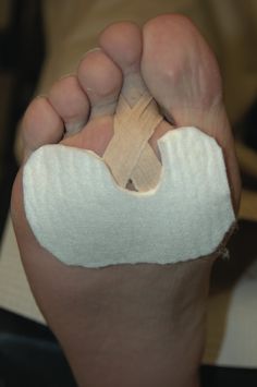 Plantar Plate Tear, Foot Pain Relief Remedies, K Tape, Foot Pain