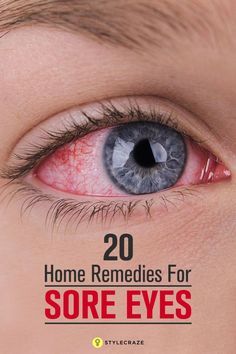 Dry Eye Remedies, Natural Headache, Irritated Eye, Eye Infections, Sore Eyes, Eyes Problems, Holistic Remedies, Headache Relief