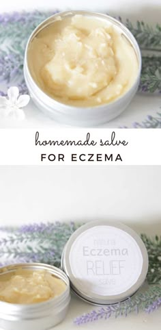 Coconut Oil For Excema, Homemade Excema Remedy, Homemade Excema Cream, Diy Excema Relief, Soap For Excema Sensitive Skin, Natural Remedy For Excema, What Helps Excema, How To Treat Excema, Natural Itch Relief Skin