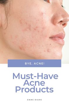 Must-Have Acne Products What Does My Acne Mean, Things To Help Hormonal Acne, What Your Acne Is Telling You, How To Deal With Hormonal Acne, Natural Remedies For Acne, Clear Skincare, Clearing Up Hormonal Acne, Back Acne, Remedies For Acne