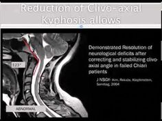 For more information on CCI visit http://www.thepainrelieffoundation.com/craniocervical-instability/Craniocervical Instability (Dr Henderson the 2012 EDNF Co... Cervical Instability, Complex Migraine, Dysautonomia Pots, Chiari Malformation, Cervical Spine, Ehlers Danlos, Fatigue Syndrome, Genetic Disorders, Ehlers Danlos Syndrome