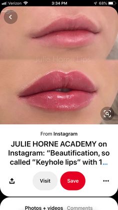 0.5 Ml Lip Filler Before And After, Lip Filler Shape Ideas, Lip Filler Before And After, Lip Filler Inspiration, Lip Fillers Juvederm, Juvederm Lips, Lips Inspiration, Botox Lips