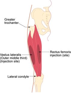 7.4 Intramuscular Injections – Clinical Procedures for Safer Patient Care