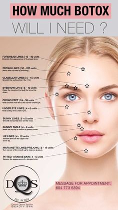 Botox Around Eyes, Botox Eyes, Aesthetic Nursing, Botox Injection Sites, Cosmetic Injections, Botox Wrinkles, Facial Injections, Botox Brow Lift, Cosmetic Fillers