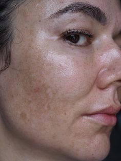 Melasma and hyperpigmentation regimen and product suggestions from The Ordinary. Plus everything else you can possibly wish to know about treating it Mum Hairstyle, Ageing Gracefully, Oval Makeup Brush, The Ordinary Skincare, Facial Aesthetics, Beauty Therapy, Beauty Tricks, Beauty Diy, Hair Solutions