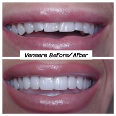 Best Veneers Teeth, Natural Veneers