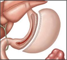 Gastric Sleeve.... Gastrectomy Diet, Sleeve Gastrectomy Diet, Vsg Surgery, Post Sleeve, Lap Band, Gastric Band, Bariatric Surgeon, Sleeve Gastrectomy, Sleeve Surgery