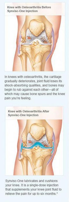 Synvisc and Hyalgan are both viscosupplements used to treat osteoarthritis. Discover their similarities and differences, including side effects and more. Tight Hip Flexors, Knee Pain Relief, Knee Replacement, Joints Pain Relief, Knee Pain, Health Advice, Looking Forward