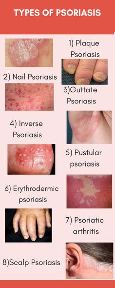 Prurigo Nodularis, Closed Comedones, Skin Blackheads, Cystic Acne Remedies, Medical School Life, Basic Anatomy And Physiology, Nursing Student Tips, Colon Health, Nursing School Survival