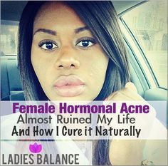 Female hormonal cystic acne almost ruined my life and after trying different acne programs, this is what I did to cure hormonal acne naturally. Read on for more Hormonal Cystic Acne, Cystic Acne Remedies, Acne Problem, Acne Free