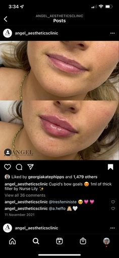 Hailey Beiber Lips Before And After, Lip Filler Before And After Round Lips, Natural Looking Filled Lips, Small Lip Injections Before And After, Lip Fuller Shapes, M Shape Lips, Lip Fillers Cupids Bow, Light Lip Injections, Lip Filler Transformation