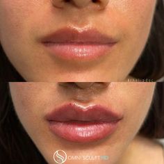 Lip Injection Before & After Gallery | OMNI SCULPT MD Lip Shapes, Cosmetic Treatments, Upper Lip, Cosmetic Procedures, Outfit Inspiration Fall