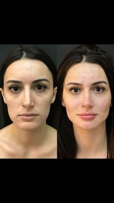 Dr. Renato Maggio - HARMONIZAÇÃO FACIAL on Instagram: "Toda mulher MERECE esse resultado!  #harmonizacaofacial #autoestima #hof #fullface #fillers #face #mulher #facial" Filler Face, 2025 Goals, Lifting Facial, Glow Up, Cosmetology, Full Face, Plastic Surgery, Asian Beauty