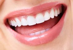 Teeth Whitening Remedies, Teeth Whitening Toothpaste, Porcelain Veneers, Teeth Shape, Dental Veneers