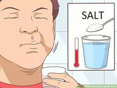 Tired of canker sores? Learn how to get rid of them at home (and when you should see a doctor)Ouch! Is that a canker sore you just noticed in your mouth? Despite their small size, mouth ulcers can cause some serious pain and add a lot of... How To Get Rid Of Mouth Ulcers, Ulcer On Tongue, Ulcer Remedies Mouth, Mouth Sore, Canker Sore Remedy, Mouth Ulcer, Tongue Sores, Home Remedies For Bronchitis