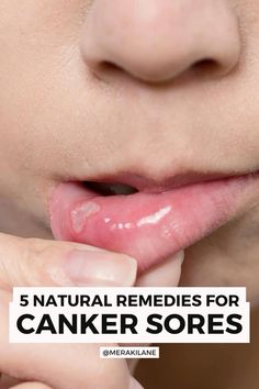 If you and/or your kids are prone to canker sores in your mouths, these canker sore remedies offer fast-acting relief.