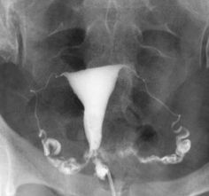 #Normal #hysterosalpingogram (#HSG) shows the #fallopian tubes are open in a #woman trying to get #pregnant. #radiology #radiologist Fallopian Tubes, Trying To Get Pregnant, Get Pregnant, A Woman