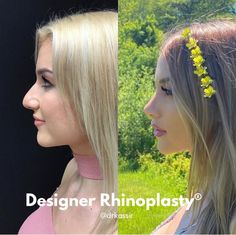 Jaw Reduction Surgery, Nose Plastic Surgery, Nose Surgery Rhinoplasty, Bulbous Nose, Plastic Surgery Fail, Rhinoplasty Nose Jobs, Face Surgery, Rhinoplasty Before And After, Plastic Surgery Gone Wrong