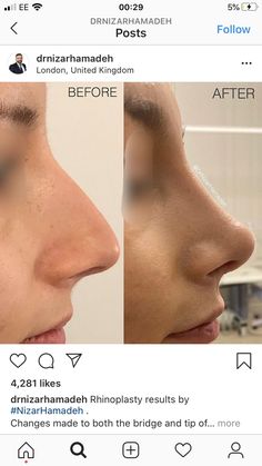 Rhinoplasty Front View, Rhinoplasty Before After, Nose Job Inspiration, Nose Fillers, Nose Types