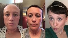 My Chemotherapy Diary: 52 Photos of Hair Loss and Recovery Losing Hair Women, How To Grow Eyebrows, Girl Haircut, New Hair Growth