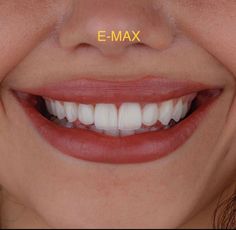 Sharp Canines, Perfect Smile Teeth, Teeth Aesthetic, Pretty Teeth, Veneers Teeth, Dental Fillings, Aesthetic Dentistry, Beautiful Teeth