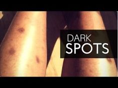 Hyperpigmentation On Legs Dark Spots, Dark Spots And Hyperpigmentation, Black Spots On Legs Remove, Dark Spots On Legs Remove Diy, How To Get Rid Of Scabs On Legs Fast, How To Get Rid Of Old Scars On Legs Fast, Black Spots On Face Remove Fast, How To Get Rid Of Dark Spots On Legs Diy, How To Get Rid Of Scars On Legs Diy