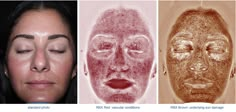 three different pictures of women with their faces covered in acne and skin pigments