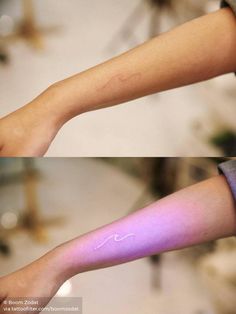 two images of the same arm with different colors on it, one showing pink and purple