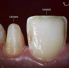 Veneers Vs Crowns, Dental Assistant Study, Dental World, Dental Aesthetics, Dental Videos, Dental Hygiene School, Kedokteran Gigi