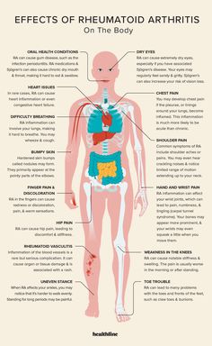 Effects of Rheumatoid Arthritis: Skeletal System, Immune, More Too Much Estrogen, Skeletal System, Estrogen Dominance, Vision Loss, Auto Immune, Oral Health Care