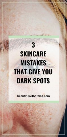 3 common skincare mistakes you're probably making that are giving you hyperpigmentation and dark spots. Skincare Mistakes, Korean Beauty Tips, Green Tea Face, Oily Skin Care Routine, Dark Under Eye, Lifestyle Habits, Acne Remedies, Facial Moisturizers