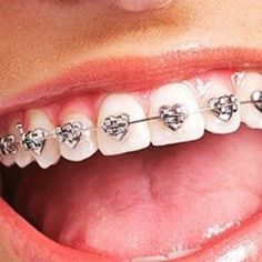 Aesthetic Braces, Dental Braces Colors, Teeth Images, Cute Braces Colors, Teeth Aesthetic, Braces Cost, Amazing Aesthetic, Braces Tips, Getting Braces