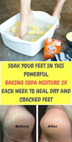 Soak Your Feet in This Powerful Baking Soda Mixture 2x Each Week To Heal Dry And Cracked Feet Skin Itching, Skin Symptoms, Nail Salon And Spa, Unhealthy Diet, Cracked Heels, Cracked Skin, Skin Disorders, Peeling Skin