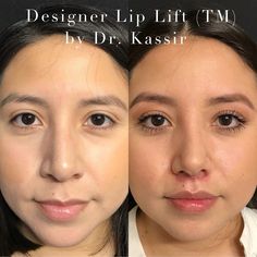 1,845 likes, 82 comments - drkassir on May 23, 2018: "Please swipe ⬅️left to see all the photos and videos for Designer 👩‍🎨 Lip Lift®️by Dr. Kassir.  Our lovely patient had revision Rhinoplasty...". Noise Job, Lip Lift Before And After, Nose Goals, Surgery Inspiration, Revision Rhinoplasty, Plastic Aesthetic, Jaw Reduction Surgery, Nose Surgery Rhinoplasty, Lip Surgery