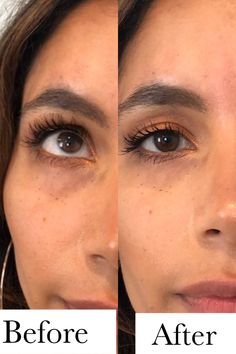 Tear Through Filler Before And After, Eye Trough Filler Before And After, Eye Fillers Before And After, Tear Trough Filler Before After, Tear Trough Filler, Under Eye Filler, Surgery Prep, Derma Fillers, Under Eye Primer