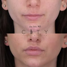 Lip Lift in New York City | Upper Lip Lift Surgery Manhattan Lip Lift Surgery, Upper Lip Lift, Face Plastic Surgery, Lip Surgery, Lip Lift, Botox Lips, Lip Augmentation, Lip Enhancement, Lower Lip