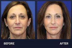 Fat Transfer Before & After Pictures | Madnani Facial Plastic Surgery Facelift Before And After, Facelift Procedure, Sagging Neck, Laser Skin Resurfacing, Medical Theme, Eyelid Lift, Fat Transfer