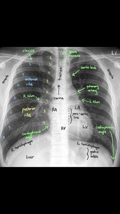 an x - ray shows the location of the chest and where it's located