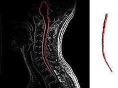 Multiple Sclerosis May Be Caused By A Virus Stem Cell Therapy, Social Behavior, Viral Infection, Alternative Therapies, Brain Development, Deep Learning, Stem Cells