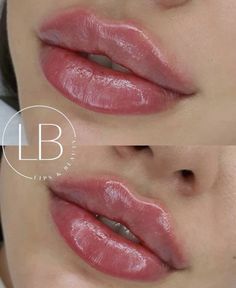 Lip Fillers Juvederm, 1ml Lip Filler, Stunning Makeup Looks, Lips Inspiration, Botox Lips, Earthy Vibes, Facial Fillers, Facial Contouring, Facial Aesthetics