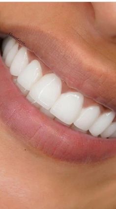 Crest 3d White, Whiter Teeth, Perfect Teeth, Whitening Kit, Teeth Whitening Kit, Oral Health Care