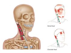 Trigger Point Therapy - Treating Whiplash – Niel Asher Healthcare Scalene Muscle, Buccal Massage, Reflexology Pressure Points, Punkty Spustowe, Neck Pain Exercises, Whiplash Injury, Massage Marketing, Natural Pain Killers, Massage Therapy Techniques