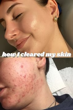 Acne can be a  journey, and a long rough one. In this video I talk about my acne journey and for anyone who might be going through the same thing I went thro... Acne Journey, Forehead Acne, Bad Acne, Natural Acne Remedies, Hormonal Acne, Face Acne