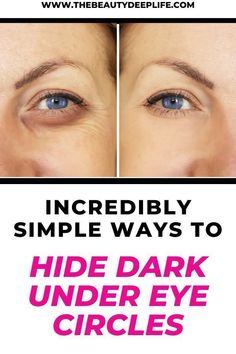 Ready to get rid of dark under eye circles?  Learn the causes and what you can do to fix them: skincare treatments, what kind of products to look for, how to conceal them with makeup, and a few lifestyle changes that could help! #skincare #makeup #beauty #health #darkcircles Dark Under Eye Circles, Color Correcting Cream, Under Eye Circles, Dark Eye Circles, Deeper Life, How To Apply Concealer, Concealer For Dark Circles