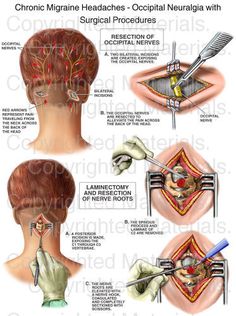 Migraine Help, Occipital Neuralgia, Headache Relief Instant, Throbbing Headache, Chiari Malformation, Migraine Pain, Migraine Prevention, Surgical Procedures, Natural Headache Remedies